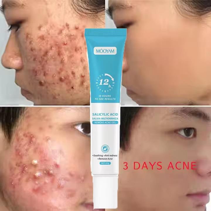 Gel anti-acné formulé à l’acide salicylique.