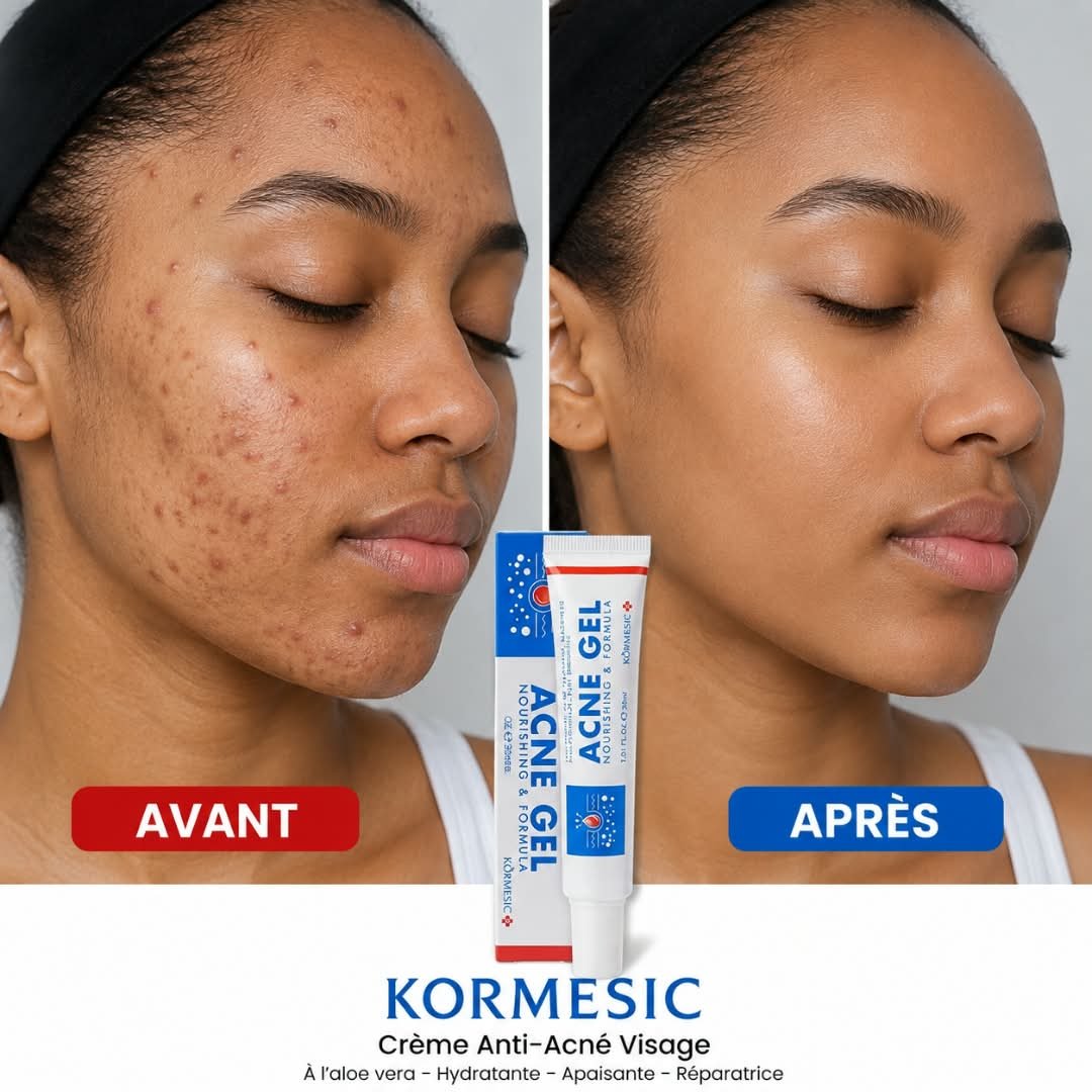 Crème Anti-Acné KORMESIC -30ml
