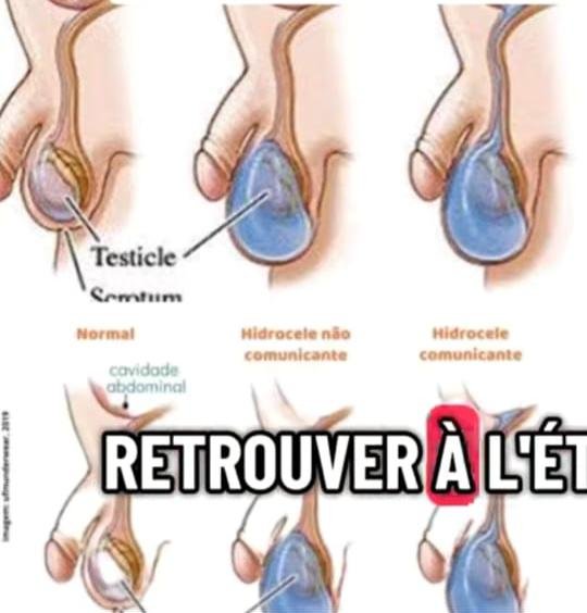 Varicocèle produits forever livving