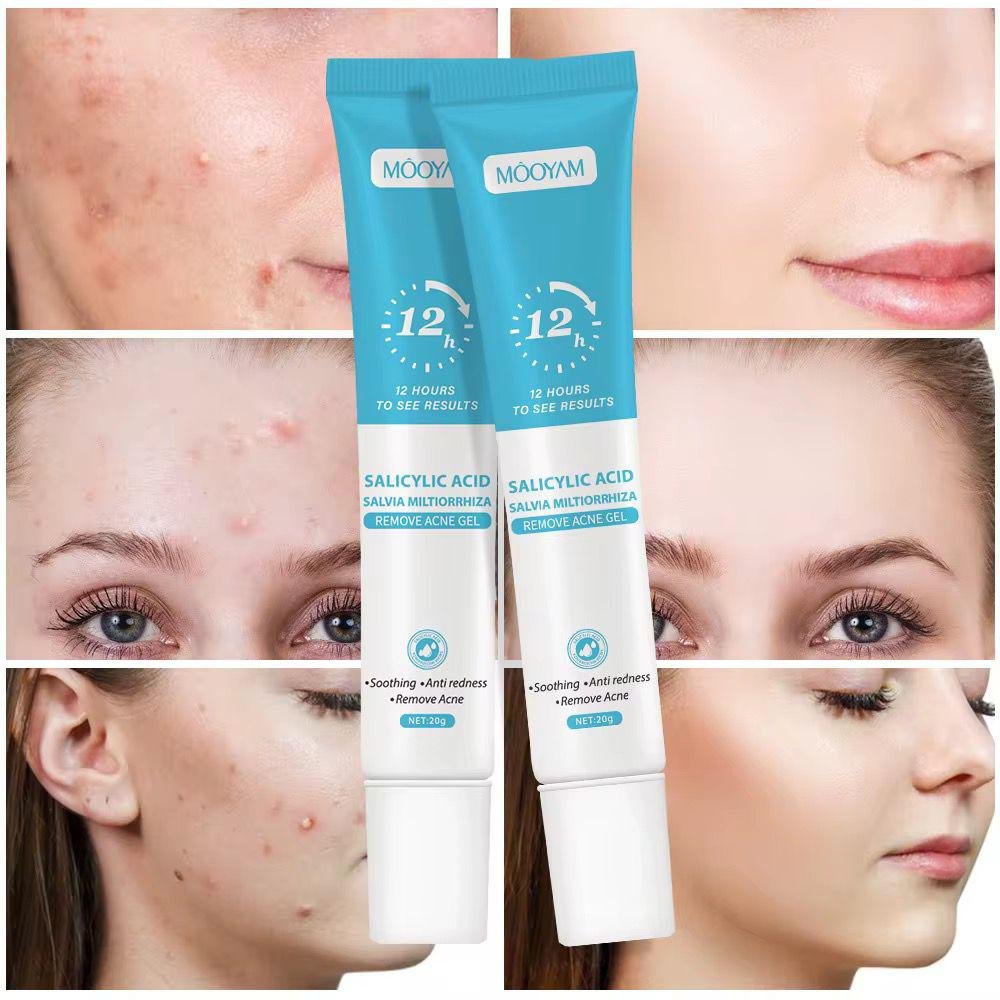 Gel Anti acné puissante